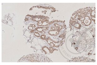 Figure 4: Human breast stained with AQP2 (brown).