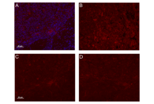 Immunohistochemistry (Formalin-fixed Paraffin-embedded Sections) validation image for anti-Osteoactivin (GPNMB) (AA 81-180) antibody (ABIN749093) (Osteoactivin anticorps  (AA 81-180))
