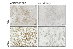 IHC staining of human brain tissue for tumor cells with anti-MYO1F antibody ABIN6997802 (1:1,000) and counterstain with hematoxylin (left panels), highlighting the sub-membranous regions in the cells. Panels on the right show images obtained without primary antibody. Magnification 100x (upper panels) and 400x (lower panels).