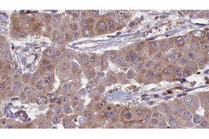 ABIN6276297 at 1/100 staining Human liver cancer tissue by IHC-P. (BVES anticorps  (Internal Region))
