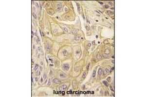 Formalin-fixed and paraffin-embedded human lung carcinoma tissue reacted with EphB2 antibody (ABIN391921 and ABIN2841731) , which was peroxidase-conjugated to the secondary antibody, followed by DAB staining. (EPH Receptor B2 anticorps)