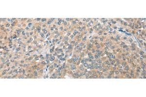 Immunohistochemistry of paraffin-embedded Human liver cancer tissue using CBR3 Polyclonal Antibody at dilution of 1:35(x200) (CBR3 anticorps)