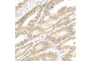 Immunohistochemistry analysis of paraffin-embedded human colon cancer using Isx (ABIN7074369) at dilution of 1: 2000 (ISX anticorps)