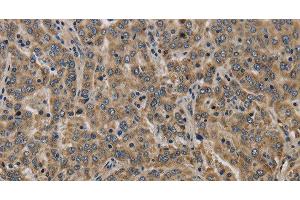 Immunohistochemistry of paraffin-embedded Human liver cancer tissue using KCNMB2 Polyclonal Antibody at dilution 1:40 (KCNMB2 anticorps)