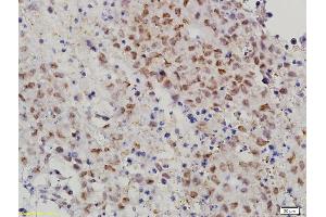 Formalin-fixed and paraffin embedded mouse cervical cancer labeled with Anti-MAT-1 Polyclonal Antibody, Unconjugated (ABIN686182) followed by conjugation to the secondary antibody and DAB staining