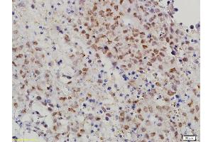 Formalin-fixed and paraffin embedded mouse cervical cancer labeled with Anti-MAT-1 Polyclonal Antibody, Unconjugated (ABIN686182) followed by conjugation to the secondary antibody and DAB staining (MTA1 anticorps  (AA 601-715))