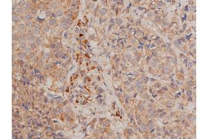 ABIN6267231 at 1/50 staining human breast cancer tissue sections by IHC-P.