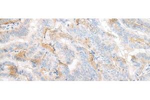 Immunohistochemistry of paraffin-embedded Human thyroid cancer tissue using TMEM248 Polyclonal Antibody at dilution of 1:25(x200) (C7orf42 anticorps)
