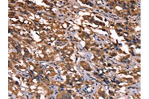 The image on the left is immunohistochemistry of paraffin-embedded Human thyroid cancer tissue using ABIN7190865(GREB1 Antibody) at dilution 1/40, on the right is treated with synthetic peptide. (GREB1 anticorps)