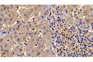 Detection of Bcl2L in Human Liver Cirrhosis Tissue using Polyclonal Antibody to B-Cell CLL/Lymphoma 2 Like Protein (Bcl2L)