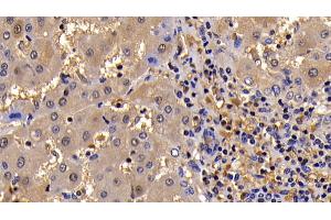 Detection of Bcl2L in Human Liver Cirrhosis Tissue using Polyclonal Antibody to B-Cell CLL/Lymphoma 2 Like Protein (Bcl2L) (BCL2L1 anticorps  (AA 2-212))