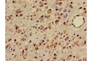 Immunohistochemistry of paraffin-embedded human glioma using ABIN7171919 at dilution of 1:100 (TTC27 anticorps  (AA 590-817))