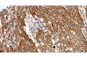 Immunohistochemistry of paraffin-embedded Human lung cancer using SSBP1 Polyclonal Antibody at dilution of 1:30 (SSBP1 anticorps)