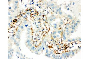 Anti-Transglutaminase 2 antibody, IHC(P) IHC(P): Human Lung Cancer Tissue