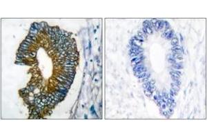 Immunohistochemistry analysis of paraffin-embedded human lung carcinoma tissue, using Keratin 18 Antibody. (Cytokeratin 18 anticorps  (AA 381-430))