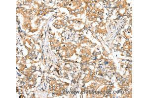 Immunohistochemistry of Human lung cancer using SIRT4 Polyclonal Antibody at dilution of 1:35 (SIRT4 anticorps)