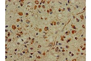 Immunohistochemistry of paraffin-embedded human glioma using ABIN7156227 at dilution of 1:100 (PFAS anticorps  (AA 1064-1302))