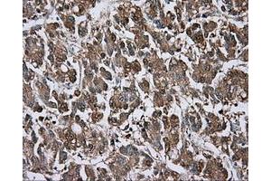 Immunohistochemical staining of paraffin-embedded Carcinoma of liver tissue using anti-BTK mouse monoclonal antibody. (BTK anticorps)