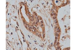 ABIN6273320 at 1/200 staining human colon cancer tissue sections by IHC-P. (SLC25A46 anticorps  (N-Term))