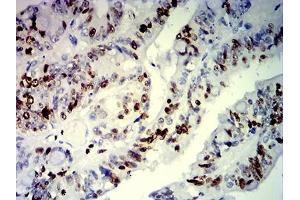 Immunohistochemical analysis of paraffin-embedded rectum cancer tissues using MKI67 mouse mAb with DAB staining. (Ki-67 anticorps  (AA 1160-1493))