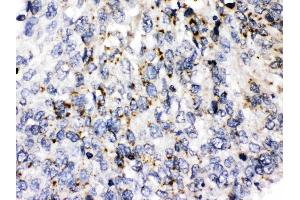 Perilipin 3 was detected in paraffin-embedded sections of human lung cancer tissues using rabbit anti- Perilipin 3 Antigen Affinity purified polyclonal antibody (Catalog # ) at 1 ? (PLIN3 anticorps  (C-Term))