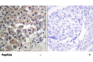 Immunohistochemistry analysis of paraffin-embedded human breast carcinoma tissue using PLCB3 polyclonal antibody .