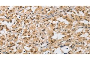 Immunohistochemistry of paraffin-embedded Human thyroid cancer tissue using AMZ2 Polyclonal Antibody at dilution 1:40