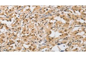 Immunohistochemistry of paraffin-embedded Human thyroid cancer tissue using AMZ2 Polyclonal Antibody at dilution 1:40 (AMZ2 anticorps)