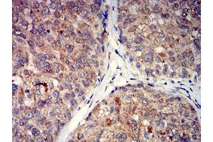 Immunohistochemical analysis of paraffin-embedded bladder cancer tissues using GRM5 mouse mAb with DAB staining. (Metabotropic Glutamate Receptor 5 anticorps  (AA 458-580))