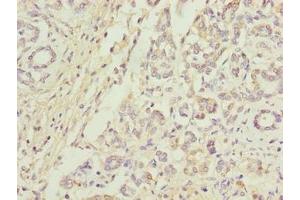 Immunohistochemistry of paraffin-embedded human pancreatic cancer using ABIN7144074 at dilution of 1:100 (ANAPC5 anticorps  (AA 2-232))