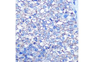 Immunohistochemistry of paraffin-embedded human liver cancer using CD13/ANPEP Rabbit mAb (ABIN7265525) at dilution of 1:100 (40x lens). (CD13 anticorps)