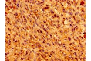 Immunohistochemistry of paraffin-embedded human melanoma using ABIN7156987 at dilution of 1:100 (IFT46 anticorps  (AA 1-304))