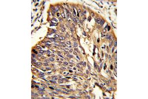 Formalin-fixed and paraffin-embedded human lung carcinoma reacted with MyD88 Antibody (Center), which was peroxidase-conjugated to the secondary antibody, followed by DAB staining.