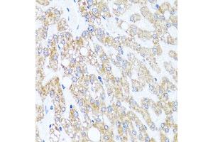 Immunohistochemistry of paraffin-embedded human liver damage using CHD1 antibody (ABIN6133620, ABIN6138500, ABIN6138501 and ABIN7101818) at dilution of 1:100 (40x lens).