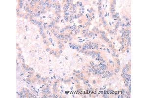 Immunohistochemistry of Human thyroid cancer using INA Polyclonal Antibody at dilution of 1:25 (INA anticorps)