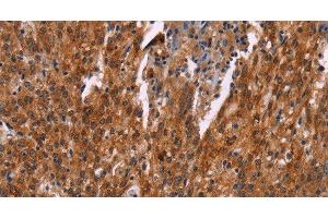 Immunohistochemistry of paraffin-embedded Human gastric cancer tissue using HSPB6 Polyclonal Antibody at dilution 1:30