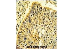 Formalin-fixed and paraffin-embedded human lung carcinoma with Calponin-1 Antibody (N-term), which was peroxidase-conjugated to the secondary antibody, followed by DAB staining.