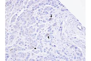 IHC-P Image Immunohistochemical analysis of paraffin-embedded MDAMB468 xenograft, using TRPM2, antibody at 1:100 dilution.