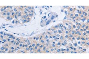 Immunohistochemistry of paraffin-embedded Human lung cancer tissue using HOXA6 Polyclonal Antibody at dilution 1:60 (HOXA6 anticorps)