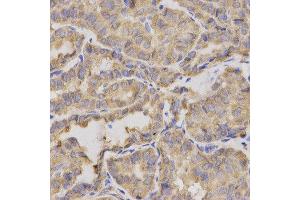 Immunohistochemistry of paraffin-embedded human thyroid cancer using XRCC2 antibody at dilution of 1:200 (x400 lens)