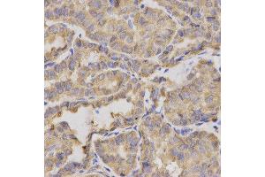 Immunohistochemistry of paraffin-embedded human thyroid cancer using XRCC2 antibody at dilution of 1:200 (x400 lens) (XRCC2 anticorps)