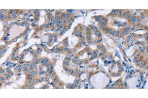 Immunohistochemistry of paraffin-embedded Human thyroid cancer using KCNQ5 Polyclonal Antibody at dilution of 1:30 (KCNQ5 anticorps)