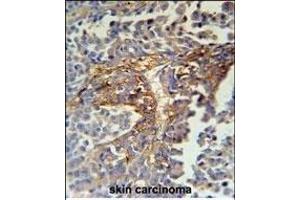 ARMC5 Antibody (C-term) (ABIN651593 and ABIN2840314) immunohistochemistry analysis in formalin fixed and paraffin embedded human skin carcinoma followed by peroxidase conjugation of the secondary antibody and DAB staining. (ARMC5 anticorps  (C-Term))