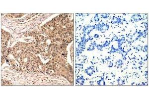 Immunohistochemical analysis of paraffin-embedded human breast carcinoma tissue using Paxillin(Phospho-Tyr118) Antibody(left) or the same antibody preincubated with blocking peptide(right). (Paxillin anticorps  (pTyr118))