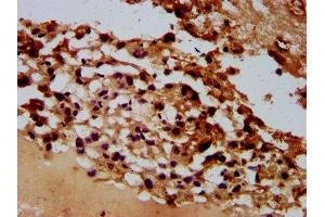 IHC image of ABIN7167931 diluted at 1:600 and staining in paraffin-embedded human melanoma performed on a Leica BondTM system. (ARHGAP15 anticorps  (AA 1-154))