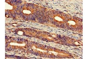 Immunohistochemistry of paraffin-embedded human colon cancer using ABIN7152309 at dilution of 1:100 (EXT2 anticorps  (AA 180-267))