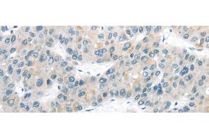 Immunohistochemistry of paraffin-embedded Human liver cancer tissue using VLDLR Polyclonal Antibody at dilution 1:40 (VLDLR anticorps)