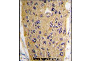 Formalin-fixed and paraffin-embedded human lung carcinoma tissue reacted with WIF1 polyclonal antibody  , which was peroxidase-conjugated to the secondary antibody, followed by DAB staining. (WIF1 anticorps  (AA 350-379))