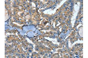 The image on the left is immunohistochemistry of paraffin-embedded Human thyroid cancer tissue using ABIN7128589(ATP4B Antibody) at dilution 1/40, on the right is treated with fusion protein. (ATP4b anticorps)