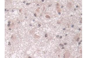 Detection of LMP7 in Human Glioma Tissue using Polyclonal Antibody to Large Multifunctional Peptidase 7 (LMP7)